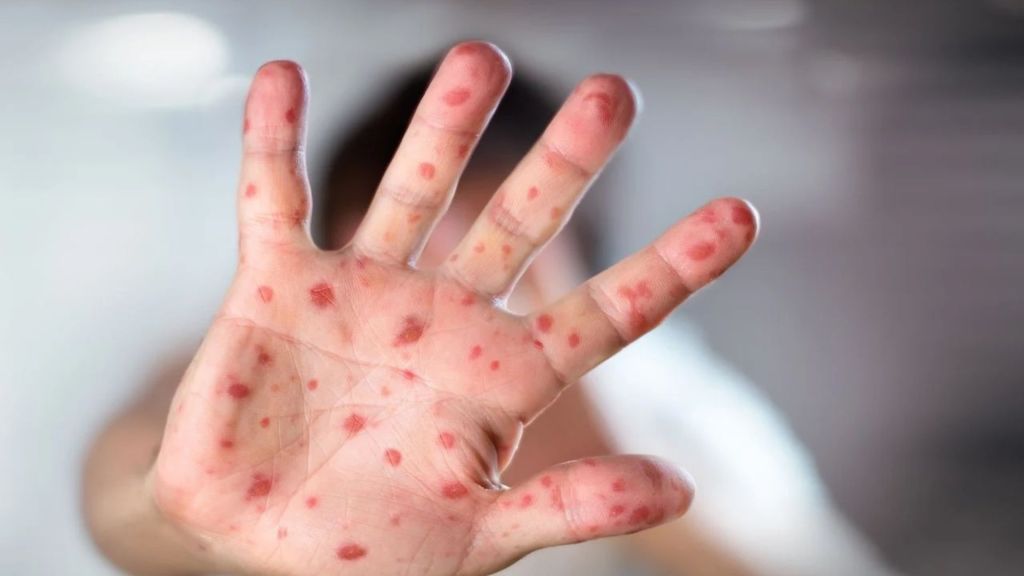 Alerta: México a un paso de perder la certificación contra el&nbsp;sarampión